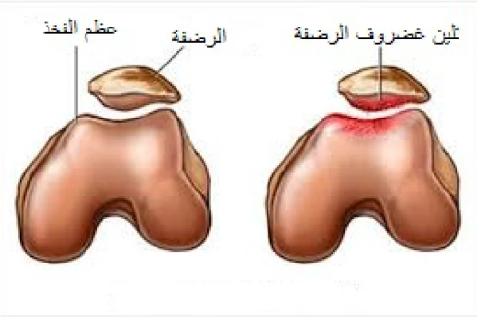 تلين غضروف الرضفة